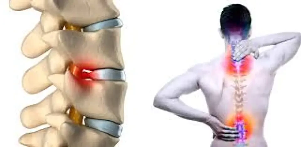 Як зменшується міжхребцева грижа: резорбція і природні можливості організму